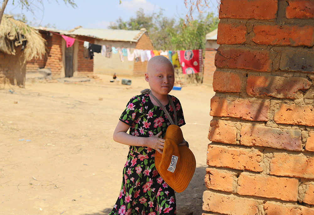 An albino child walks past her house to hide from visitors in Mtendere, Malawi. Children with albinism have been the victims of a surge of attacks by people seeking to use their body parts in ritual practices.